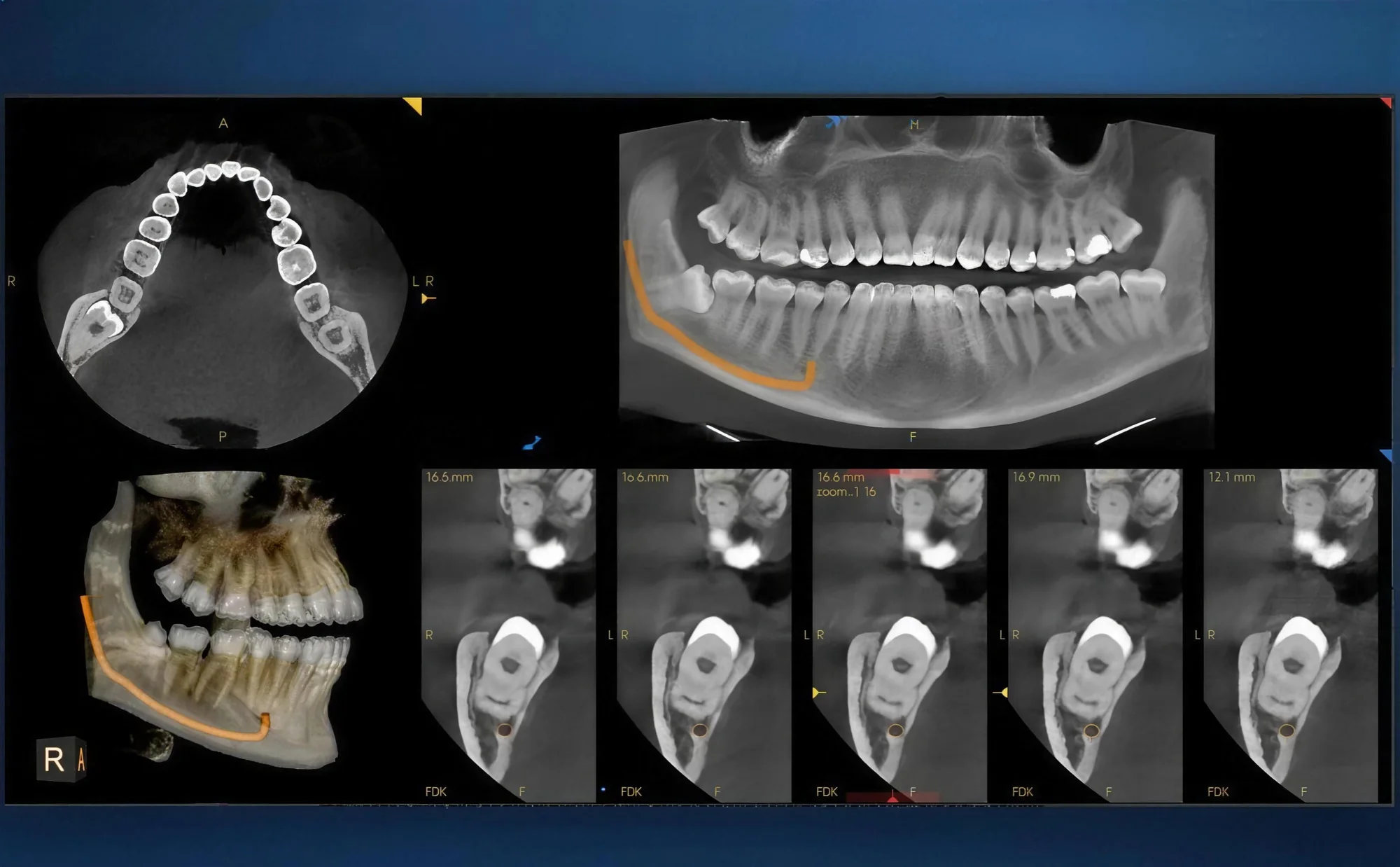 Imagem de CBCT 3D em análise